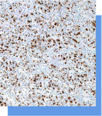 Renal Cell Carcinoma Marker抗體試劑